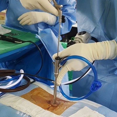 endoscopic spine surgery