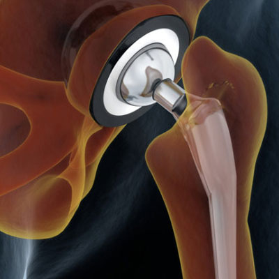 joint replacement surgery 